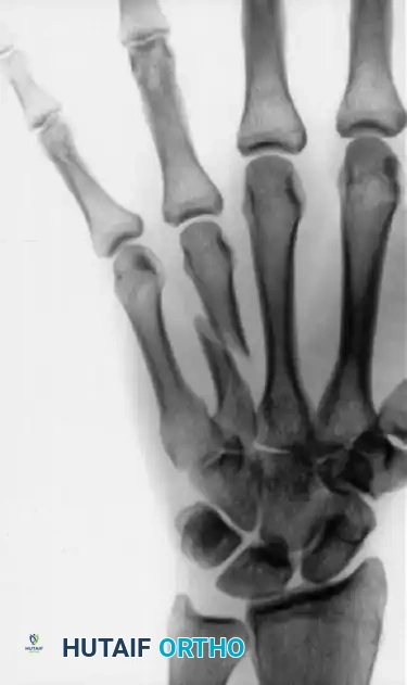 CLOSED PINNING Surgical Diagram