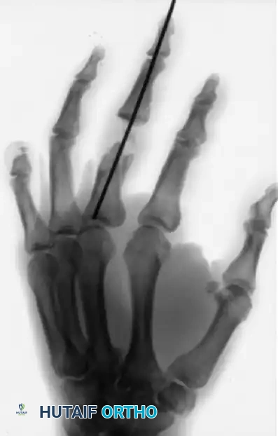 CLOSED PINNING Surgical Diagram
