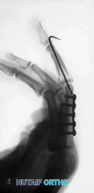 CLOSED PINNING Surgical Diagram