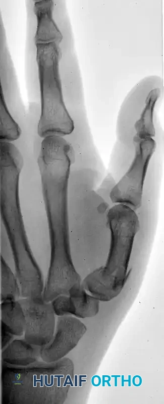 CLOSED PINNING Surgical Diagram