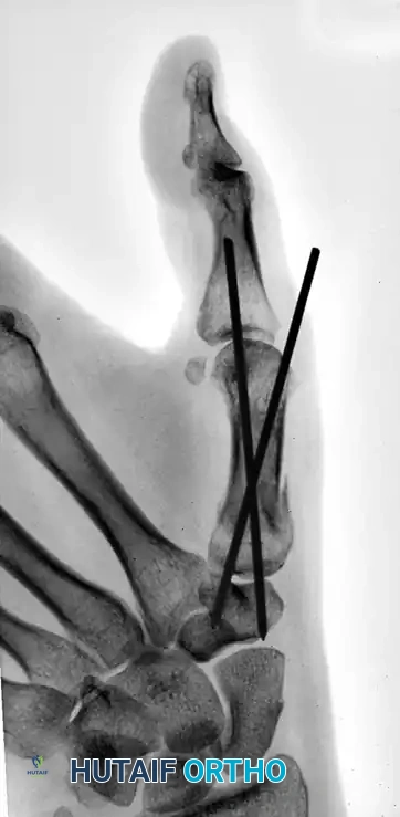 CLOSED PINNING Surgical Diagram