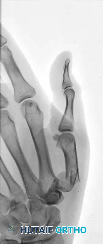 CLOSED PINNING Surgical Diagram