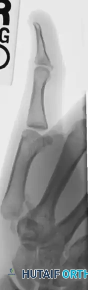 CLOSED PINNING Surgical Diagram