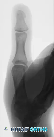 CLOSED PINNING Surgical Diagram