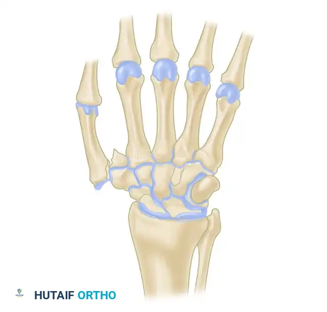 FIGURE 67-10 Wagner technique of closed pinning of Bennett fracture (see text).