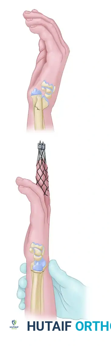 CLOSED REDUCTION AND PERCUTANEOUS PINNING OF DISTAL RADIAL FRACTURE Surgical Diagram