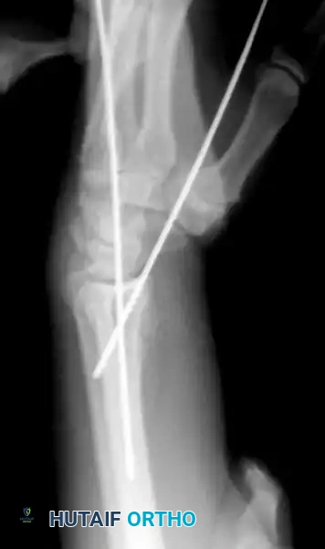 CLOSED REDUCTION AND PERCUTANEOUS PINNING OF DISTAL RADIAL FRACTURE Surgical Diagram
