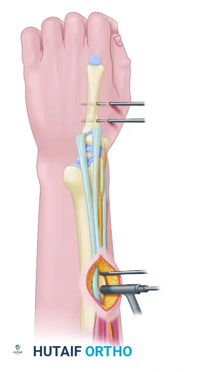 BR Radial sensory nerve