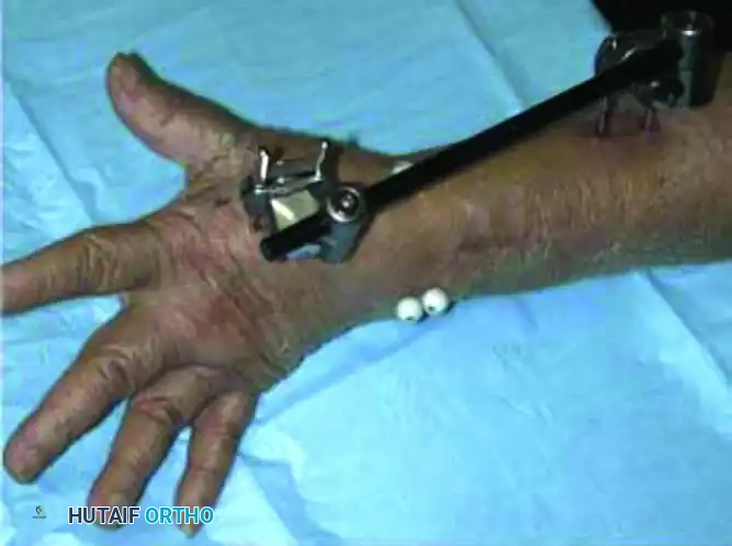 CLOSED REDUCTION AND PERCUTANEOUS PINNING OF DISTAL RADIAL FRACTURE Surgical Diagram