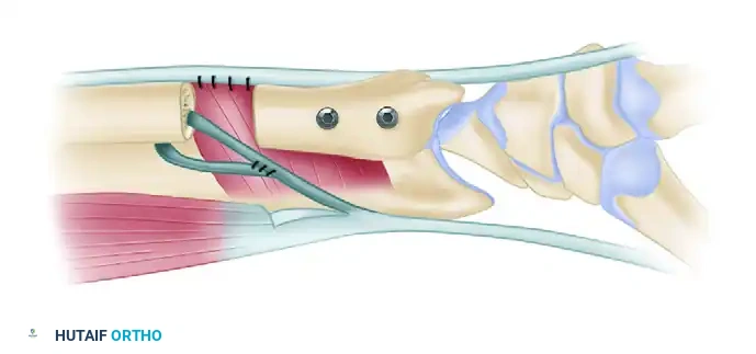 Arthroscopic Wafer Procedure & TFCC Debridement