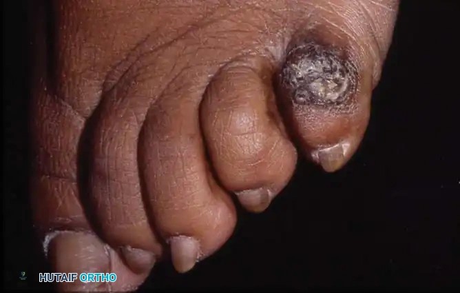 Fig. 80-21 Acutely inﬂ amed hard corn over dorsolateral surface of ﬁ fth toe with swelling, heat, and erythema.