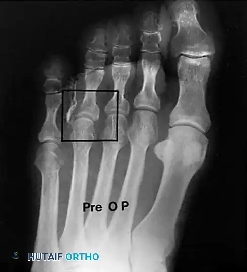 Fig. 80-24 Infected soft corn. Note opaque material for sinogram and lytic changes at base of proximal phalanx (box) .