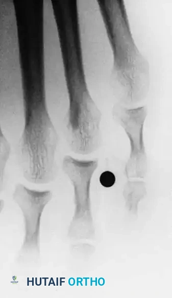 Fig. 80-23 A, Fourth web space interdigital corn. B, Corresponding radiograph with marker overlying corn. Note two-boned ﬁ fth toe and abnormally short ﬁ fth metatarsal. C, Oblique view showing apposition of base of fourth proximal phalanx and head of ﬁ fth proximal phalanx.