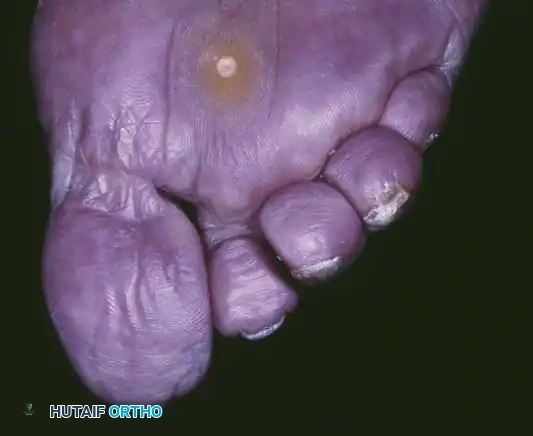 Fig. 80-25 Plantar keratosis. A, Intractable plantar keratosis; note prominent lateral condyle of second metatarsal head. B, Intractable plantar keratosis beneath second metatarsal head.