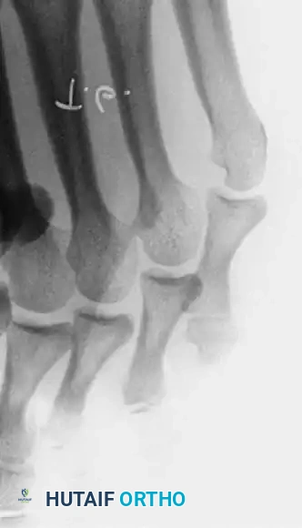 Fig. 80-23 A, Fourth web space interdigital corn. B, Corresponding radiograph with marker overlying corn. Note two-boned ﬁ fth toe and abnormally short ﬁ fth metatarsal. C, Oblique view showing apposition of base of fourth proximal phalanx and head of ﬁ fth proximal phalanx.
