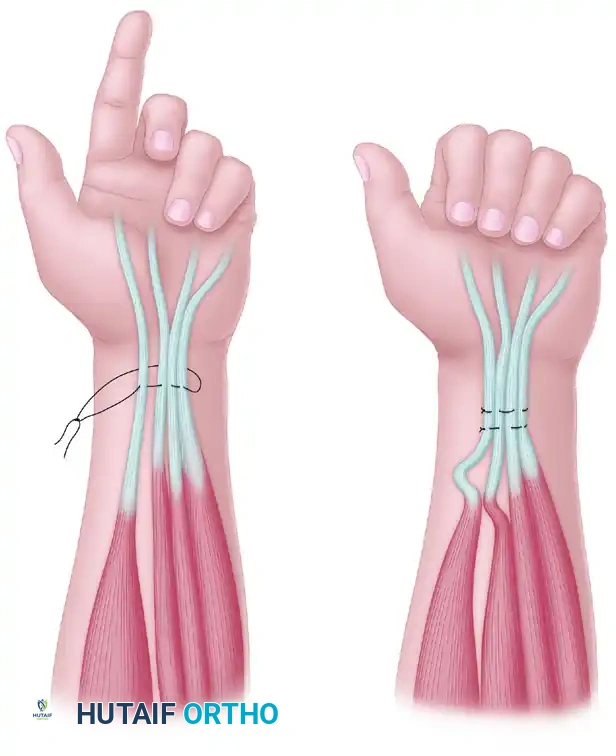 Surgical Reconstruction of Combined High Median-Ulnar Nerve Palsy and Tetraplegia