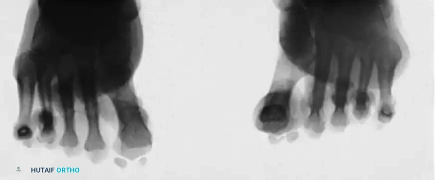 COMPLICATIONS AFTER SURGERY FOR HALLUX VALGUS Surgical Diagram