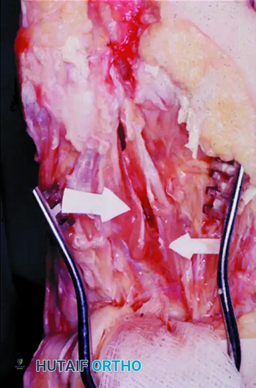 COMPLICATIONS AFTER SURGERY FOR HALLUX VALGUS Surgical Diagram