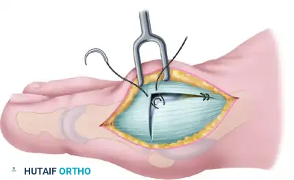 COMPLICATIONS AFTER SURGERY FOR HALLUX VALGUS Surgical Diagram