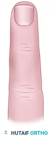 Complications of Hand Fractures: Reconstructive Hierarchy, Malunion, and Mallet Fracture Fixation