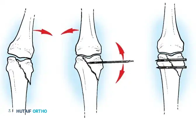 COMPLICATIONS OF HAND FRACTURES Surgical Diagram