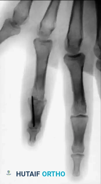 COMPLICATIONS OF HAND FRACTURES Surgical Diagram