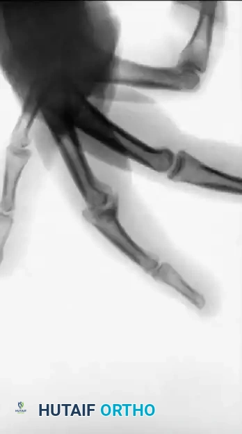 COMPLICATIONS OF HAND FRACTURES Surgical Diagram