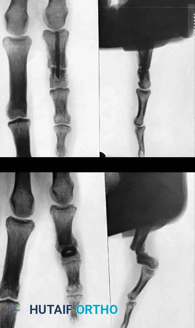 COMPLICATIONS OF HAND FRACTURES Surgical Diagram