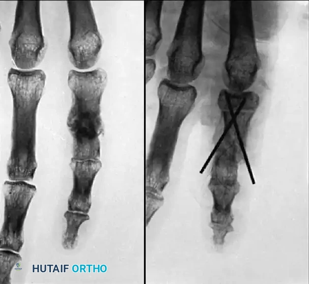COMPLICATIONS OF HAND FRACTURES Surgical Diagram