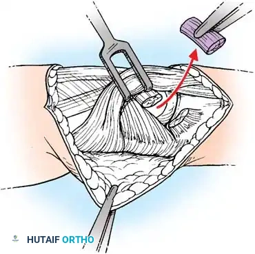 COMPLICATIONS OF HAND FRACTURES Surgical Diagram