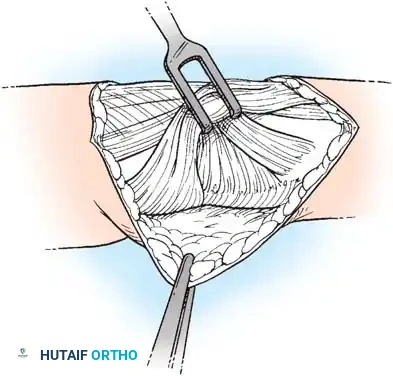 COMPLICATIONS OF HAND FRACTURES Surgical Diagram