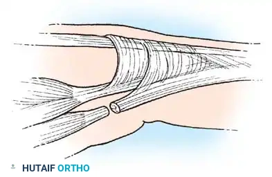 COMPLICATIONS OF HAND FRACTURES Surgical Diagram