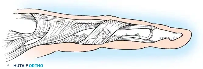 COMPLICATIONS OF HAND FRACTURES Surgical Diagram