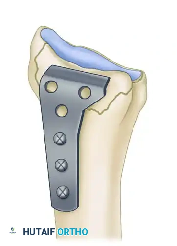 Complications of Distal Radius Fractures: Prevention, Biomechanics, and Surgical Management