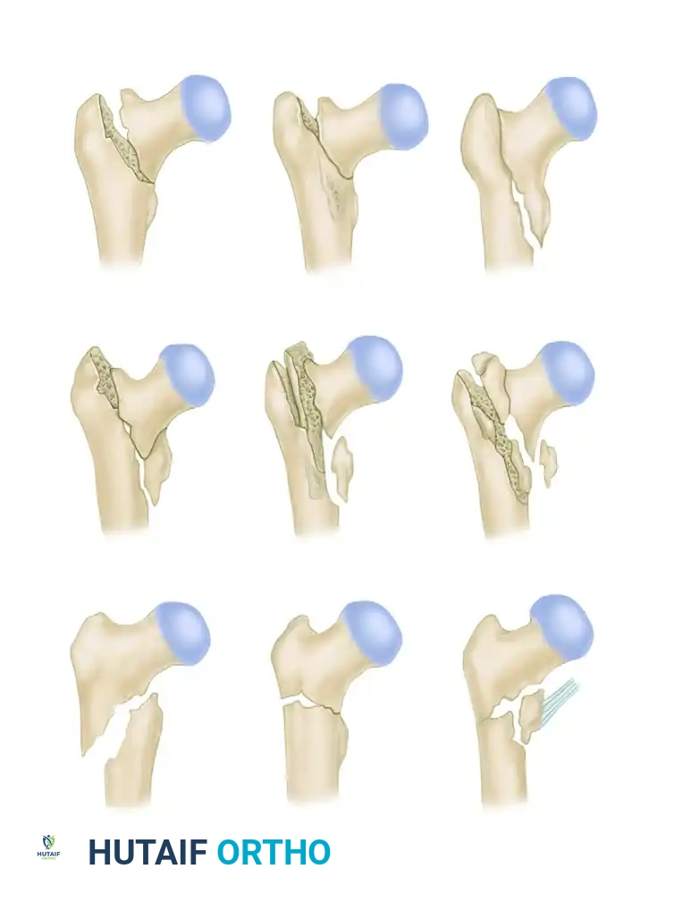 Compression Hip Screw Fixation for Intertrochanteric Fractures