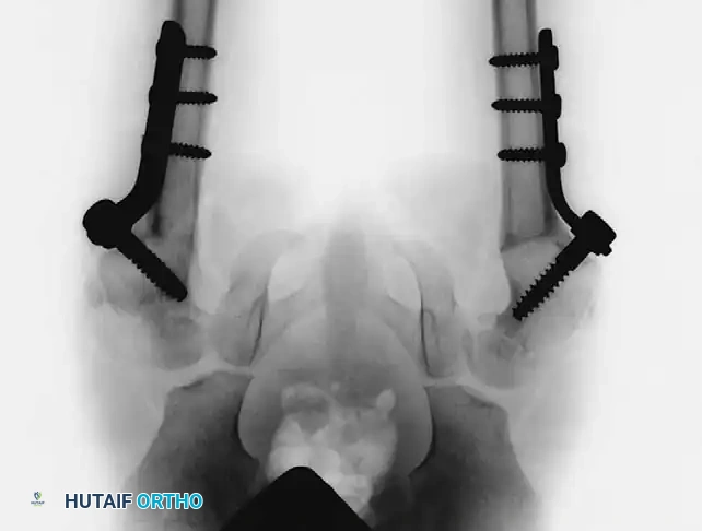 Fig. 27-36 Congenital coxa vara. C, After bilateral subtrochanteric osteotomies and internal ﬁ xation with pediatric hip screw.