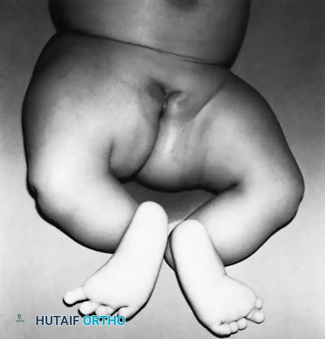 Fig. 26-67 Bilateral tibial hemimelia in 3-month-old girl; note absence of great toe on right foot, severe varus deformities of feet, and ﬁ xed knee ﬂ exion contractures.