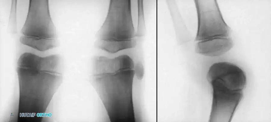 Fig. 26-65 Untreated congenital dislocation of left patella in 5-year-old boy. A, Anteroposterior view shows ﬁ xed lateral dislocation. B, On lateral view, patella appears absent because of superimposed femoral condyles.