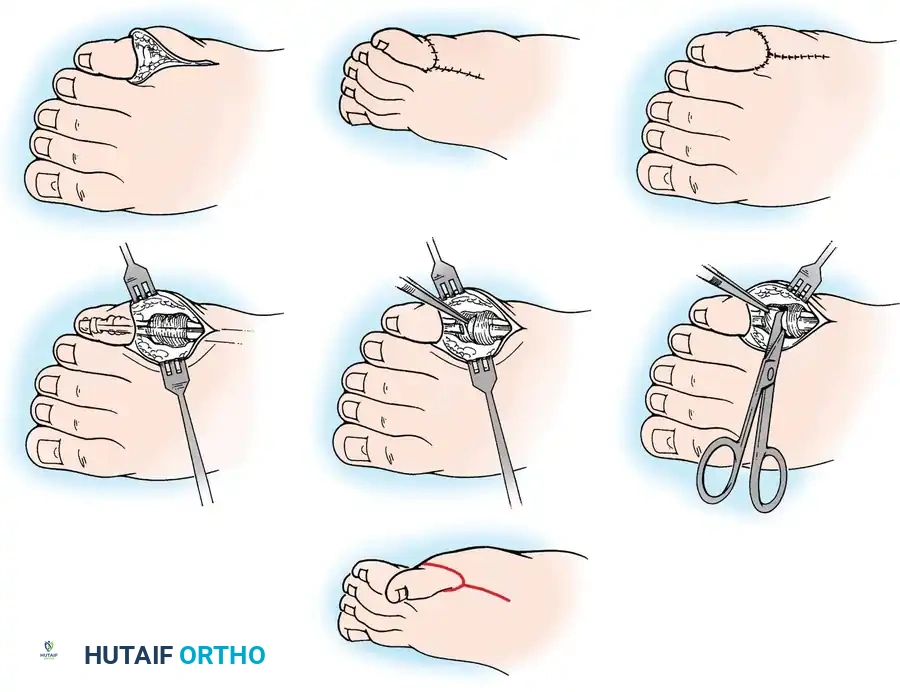 Butler Arthroplasty Diagram