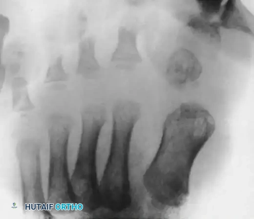 Clinical Appearance of Congenital Hallux Varus