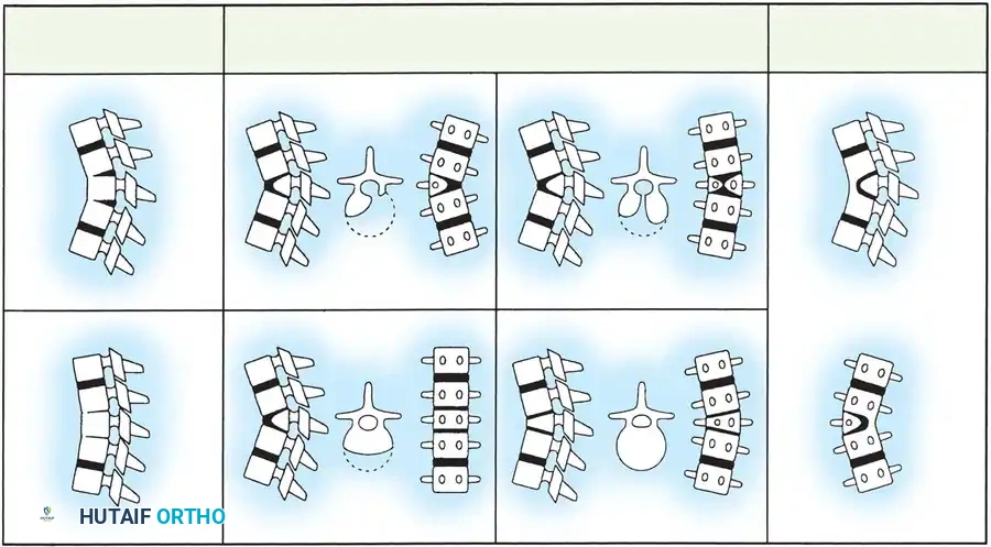Different types of vertebral anomalies