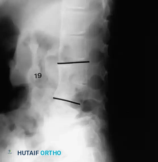 Surgical Diagram: Posterior Exposure