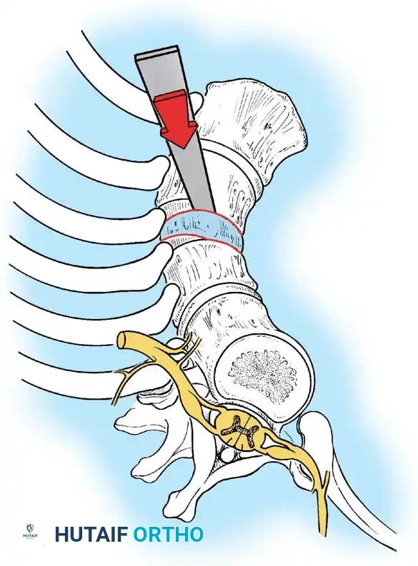 Surgical Diagram: Retraction and Exposure