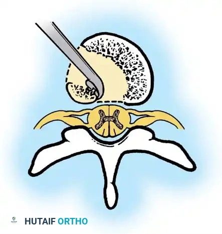 Surgical Diagram: Strut Graft Preparation