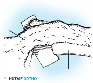 Surgical Diagram: Discectomy