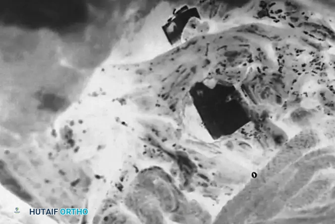 Surgical Diagram: Posterior Instrumentation
