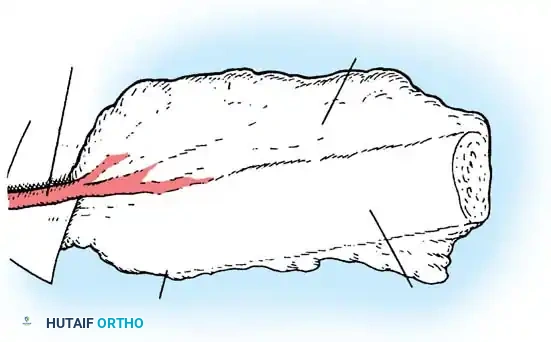 Surgical Diagram: Final Construct