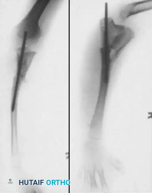 Congenital Pseudarthrosis of the Ulna and Radioulnar Synostosis: A Masterclass in Surgical Management