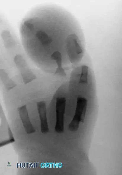 CONGENITAL RING SYNDROME Surgical Diagram