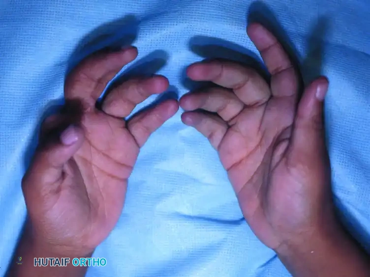 CONGENITAL RING SYNDROME Surgical Diagram